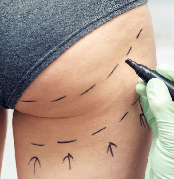 liposuction-costs-in-turkey