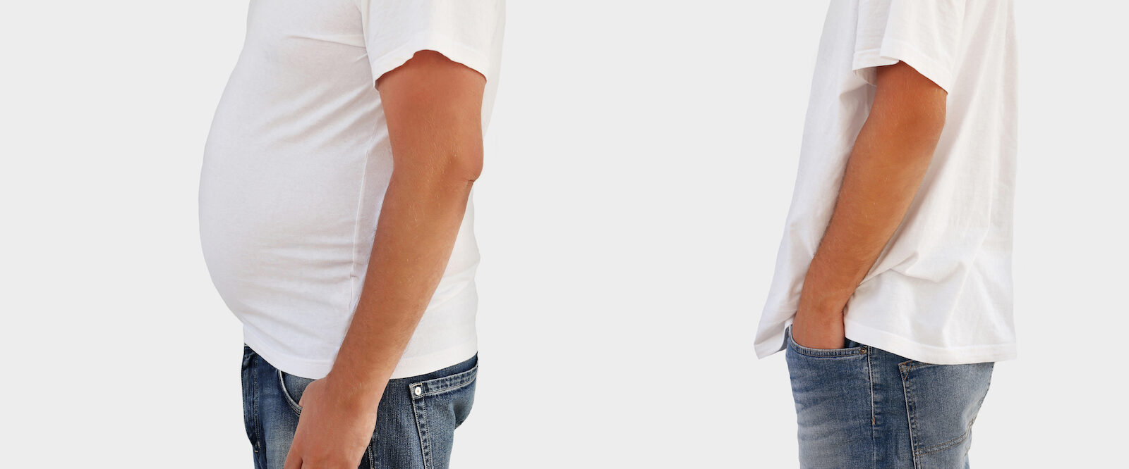obesity-surgery-in-turkey