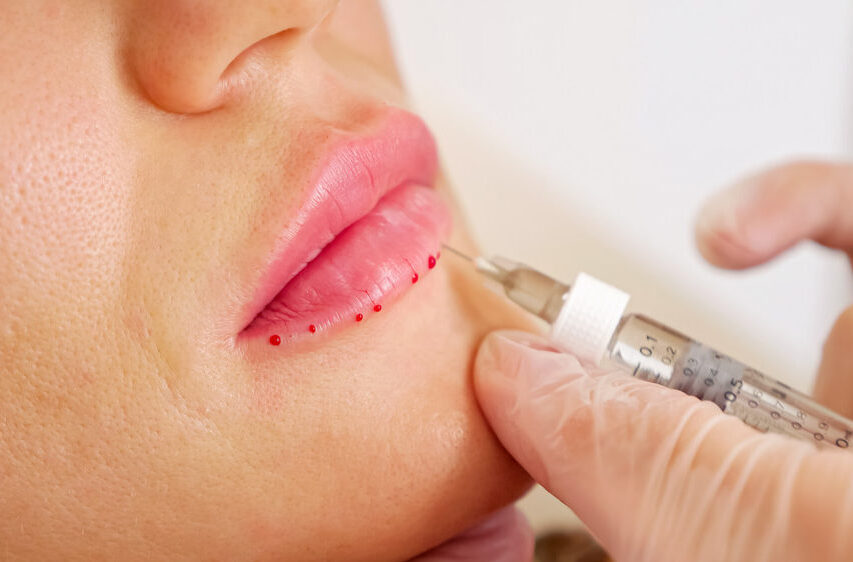 lip-fillers-aesthetics