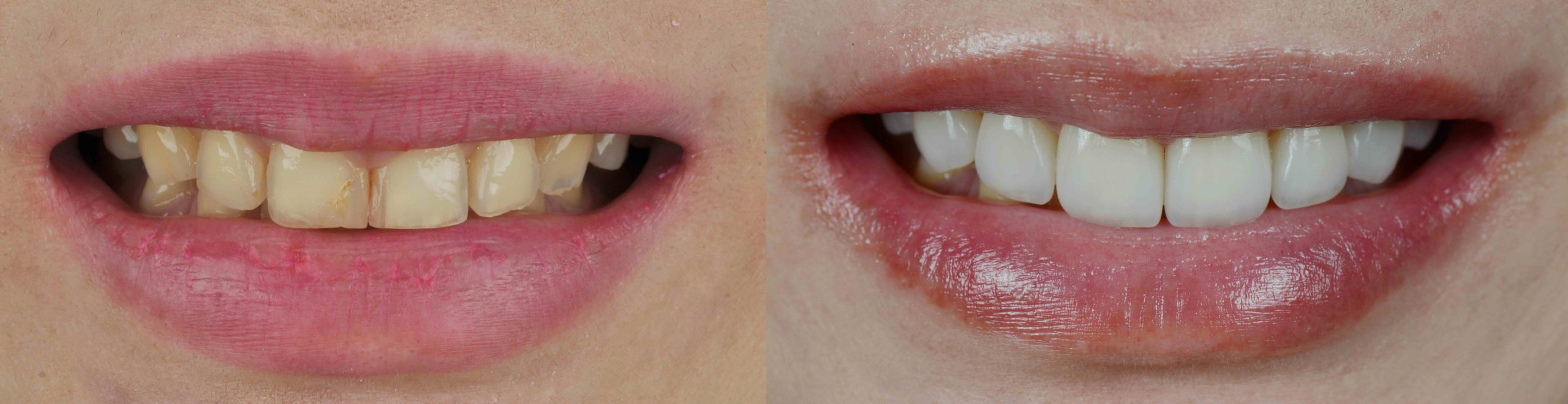 Smile makeover with dental ceramic veneers treatment result in clean, perfect, youth and white teeth smile. Before and after close up full mouth.