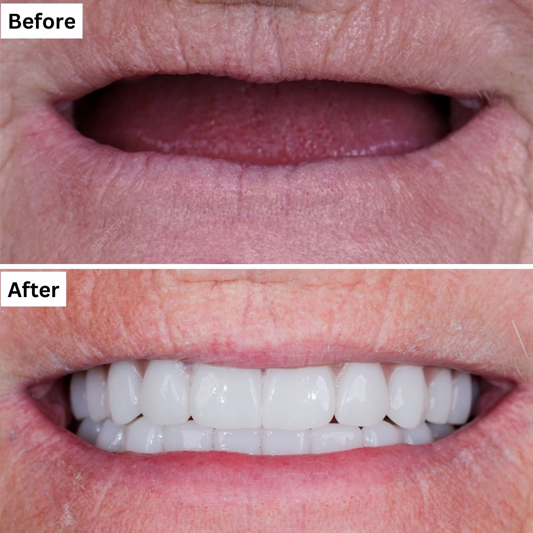 dental-implants-dentspa Dental Implants in Dentspa