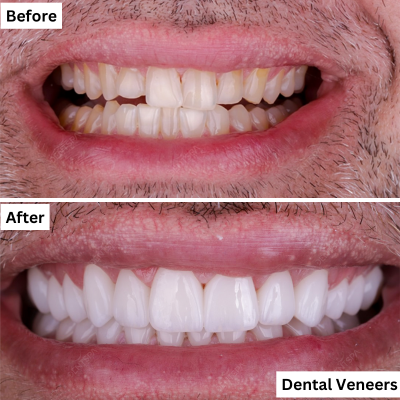Dental Veneer Procedure in Dentspa