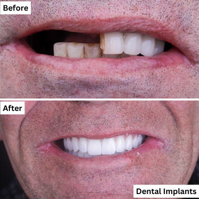 Dental Implant Procedure in Dentspa
