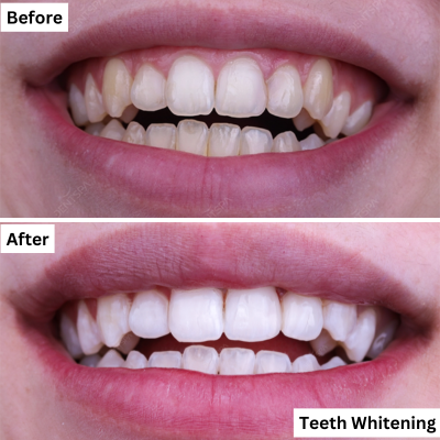 Teeth Whitening Procedure in Dentspa